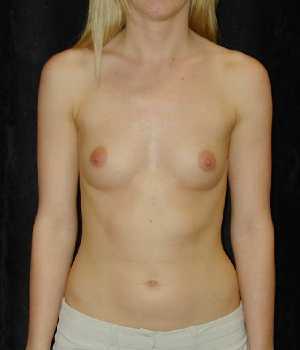 Breast Augmentation Surgery