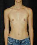 Breast Implant