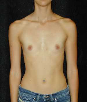 Breast Augmentation Surgery