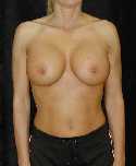 Breast Implant