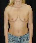 Breast Implant