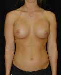 Breast Implant