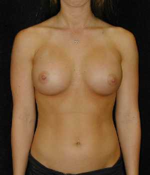 Breast Augmentation Surgery