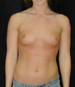 Breast Augmentation Surgery