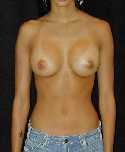 Breast Implant