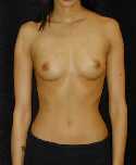 Breast Implant