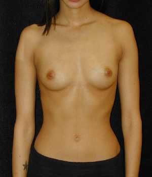 Breast Augmentation Surgery