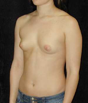 Breast Augmentation Surgery