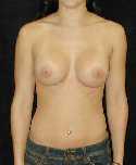 Breast Implant