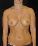 Breast Implant