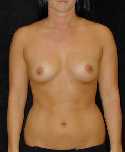 Breast Implant