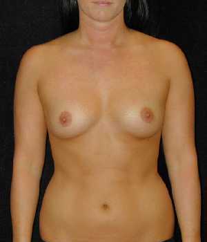 Breast Augmentation Surgery