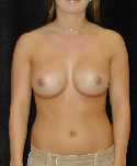 Breast Implant