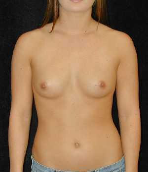 Breast Augmentation Surgery