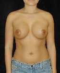 Breast Implant