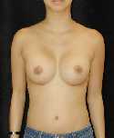 Breast Implant