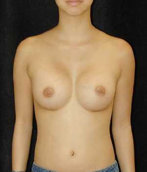 Breast Augmentation Surgery