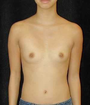 Breast Augmentation Surgery