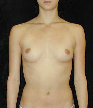 Breast Augmentation Surgery