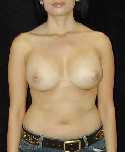 Breast Implant