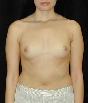 Breast Augmentation Surgery