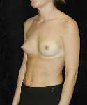 Breast Implant