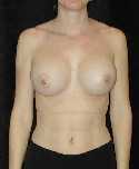 Breast Implant