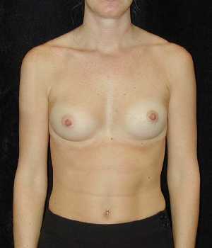 Breast Augmentation Surgery