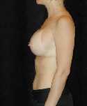 Breast Implant