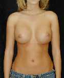 Breast Implant