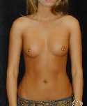 Breast Implant