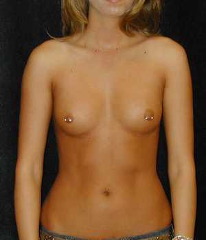 Breast Augmentation Surgery