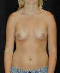 Breast Implant