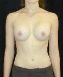 Breast Implant