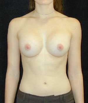 Breast Augmentation Surgery