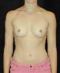 Breast Implant