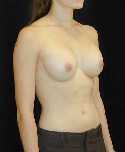 Breast Implant