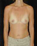 Breast Implant