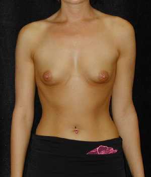 Breast Augmentation Surgery