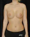 Breast Implant