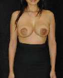 Breast Implant Revision Surgery