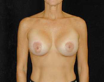 Breast Lift Surgery