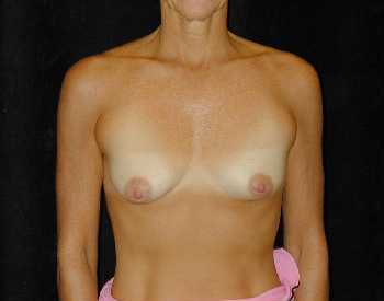 Breast Lift Surgery