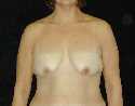 Breast Lift Surgery