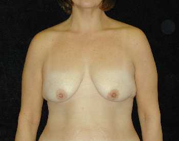 Breast Lift Surgery