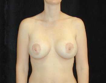 Breast Lift Surgery