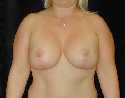 Breast Lift Surgery