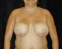 Breast Lift Surgery