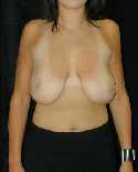 Breast Reduction Surgery