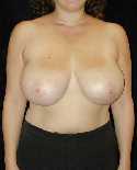 Breast Reduction Surgery